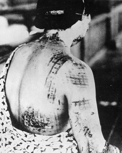 Skin of A-bomb victim is burned in a pattern corresponding to the dark portions of a kimono.